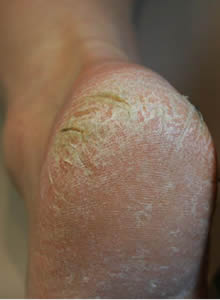 hard skin feet